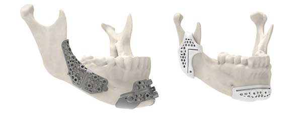 3D Systems Attains FDA Clearance for Materials for 3D Printed Surgical Guides