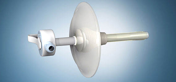 Healthcare Grant from Protolabs Leads to Innovative Feeding Tube Inventions